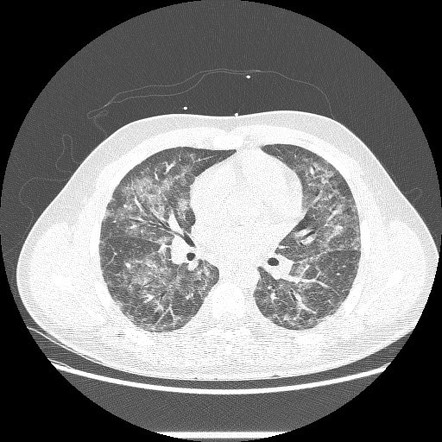 Vaping associated lung disease Radiology Reference Article