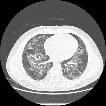 Vaping-associated Lung Injury | Radiology Case | Radiopaedia.org