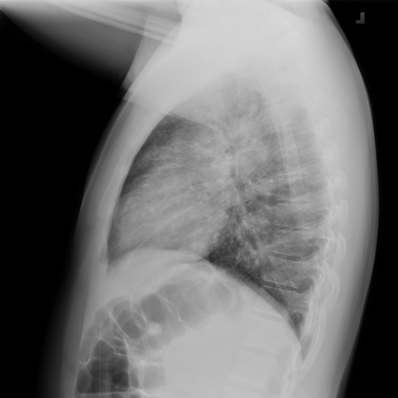 Vaping-associated lung injury | Image | Radiopaedia.org