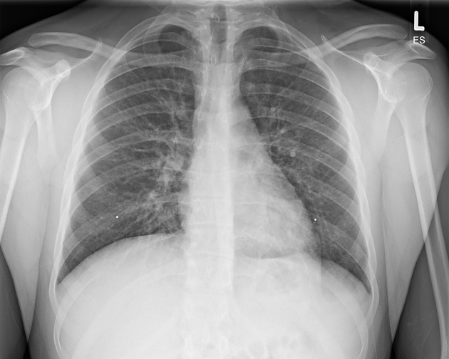 Vaping associated lung injury Radiology Case Radiopaedia