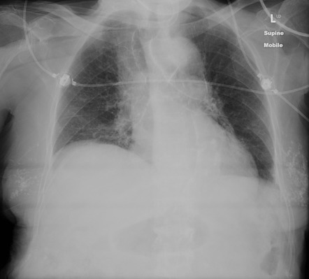 Benign breast calcifications - bilateral (chest x-ray) | Radiology Case ...