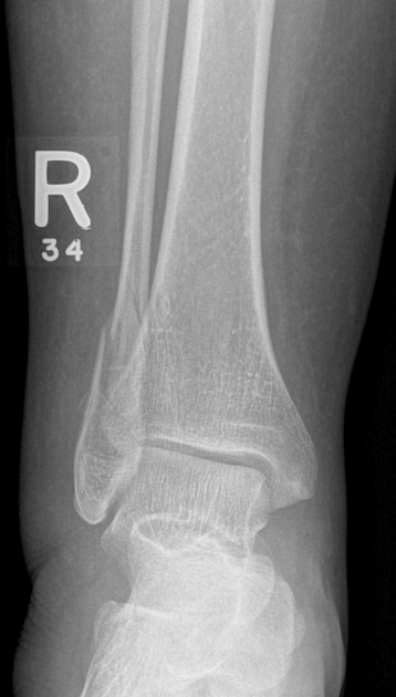 Ankle fracture Weber C Radiology Case Radiopaedia