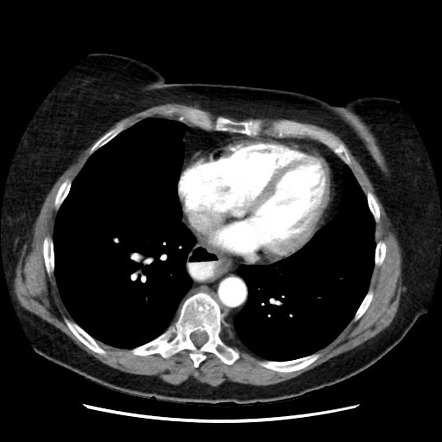 Esophageal cancer | Image | Radiopaedia.org