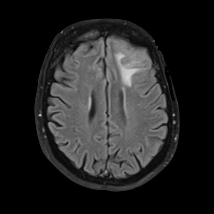 Dural Metastases From Breast Cancer | Image | Radiopaedia.org