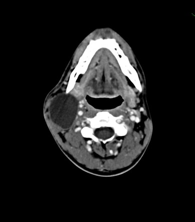 2nd branchial cleft cyst | Radiology Case | Radiopaedia.org