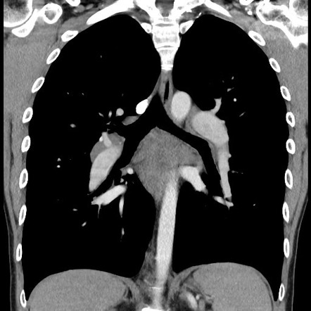 Sarcoidosis associated pulmonary arterial hypertension | Image ...