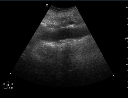 Inferior vena cava thrombosis | Radiology Case | Radiopaedia.org