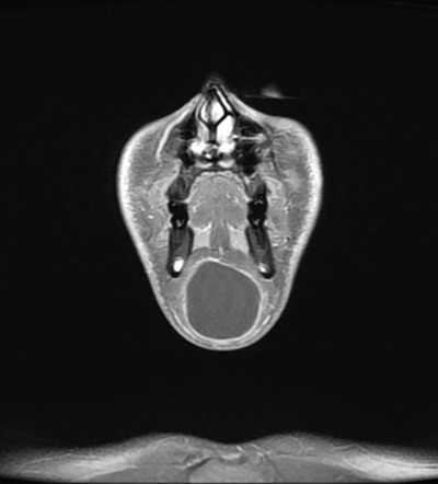 Submental dermoid cyst | Image | Radiopaedia.org