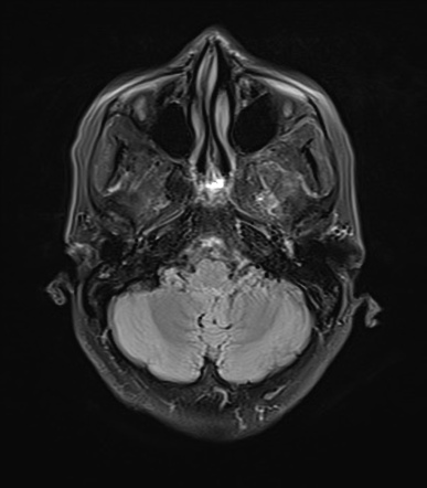 Glomus jugulotympanicum | Image | Radiopaedia.org