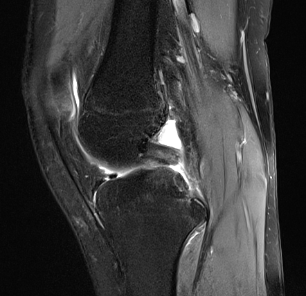 Posterior cruciate ligament tear | Radiology Case | Radiopaedia.org