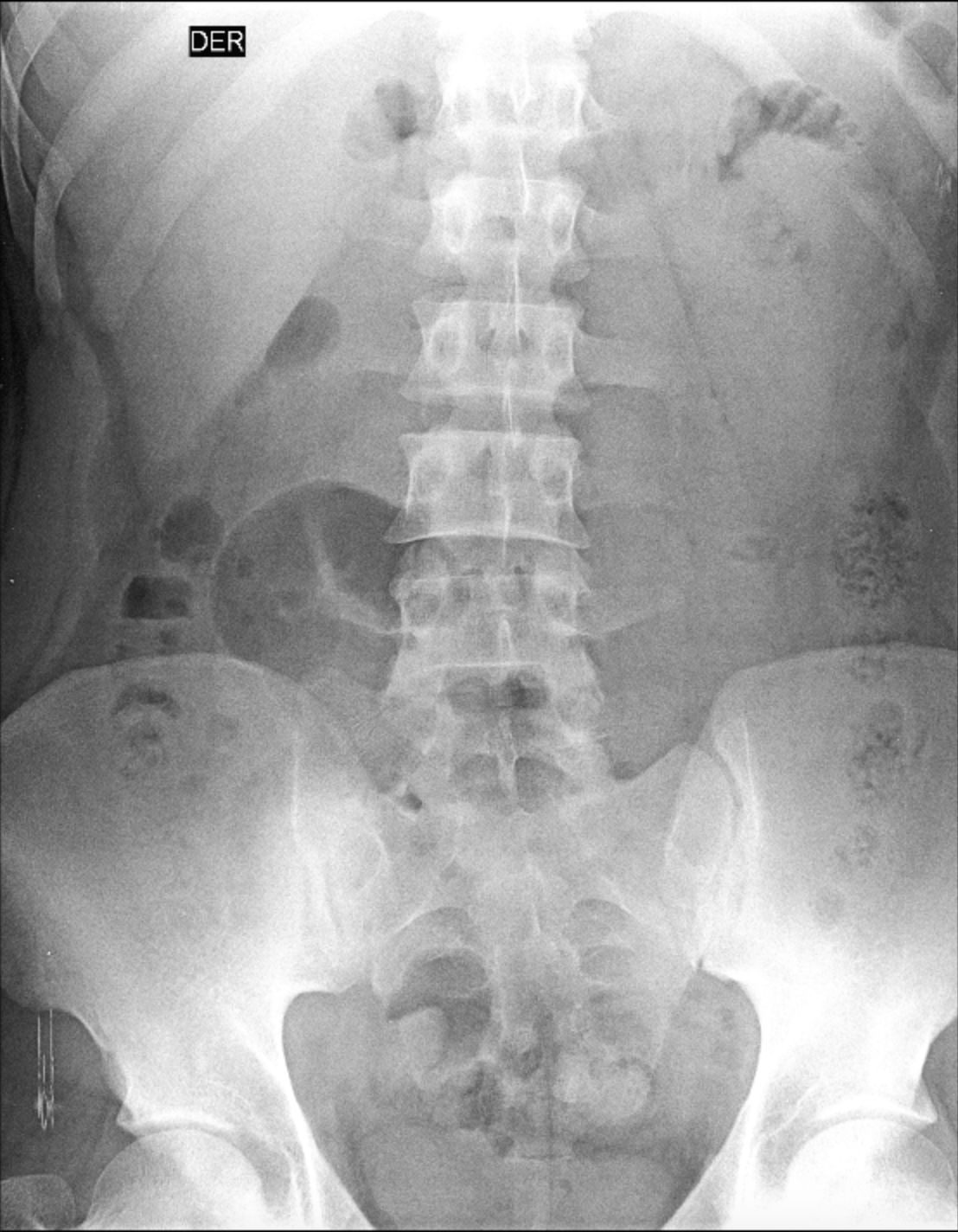 Lumbosacral transitional vertebra - Castellvi IIIa | Image ...