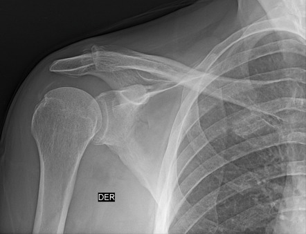 Calcific Tendinitis Of Supraspinatus Tendon Radiology Case