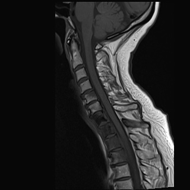 Breast Cancer Metastases Cervical Spine Radiology Case Radiopaedia Org