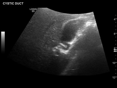 Cystic duct (ultrasound) | Radiology Case | Radiopaedia.org