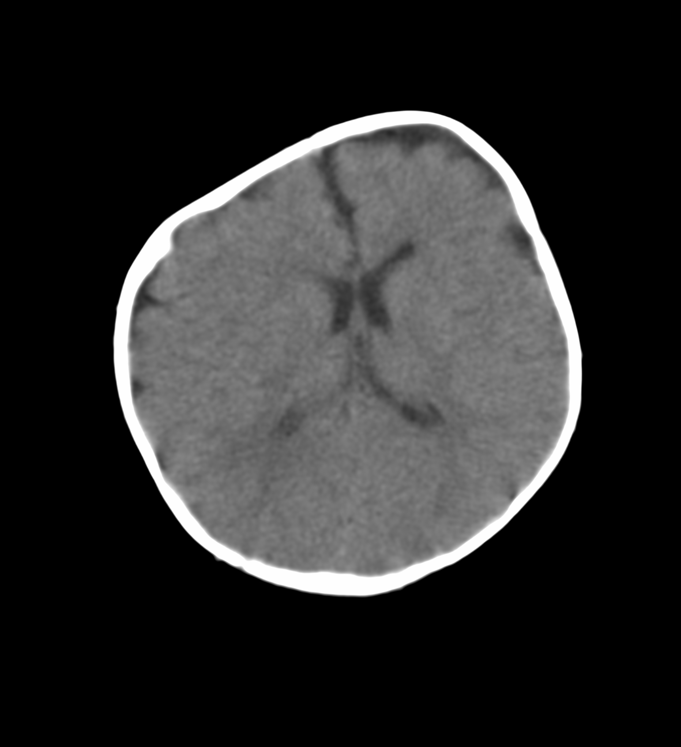 Anterior plagiocephaly | Image | Radiopaedia.org