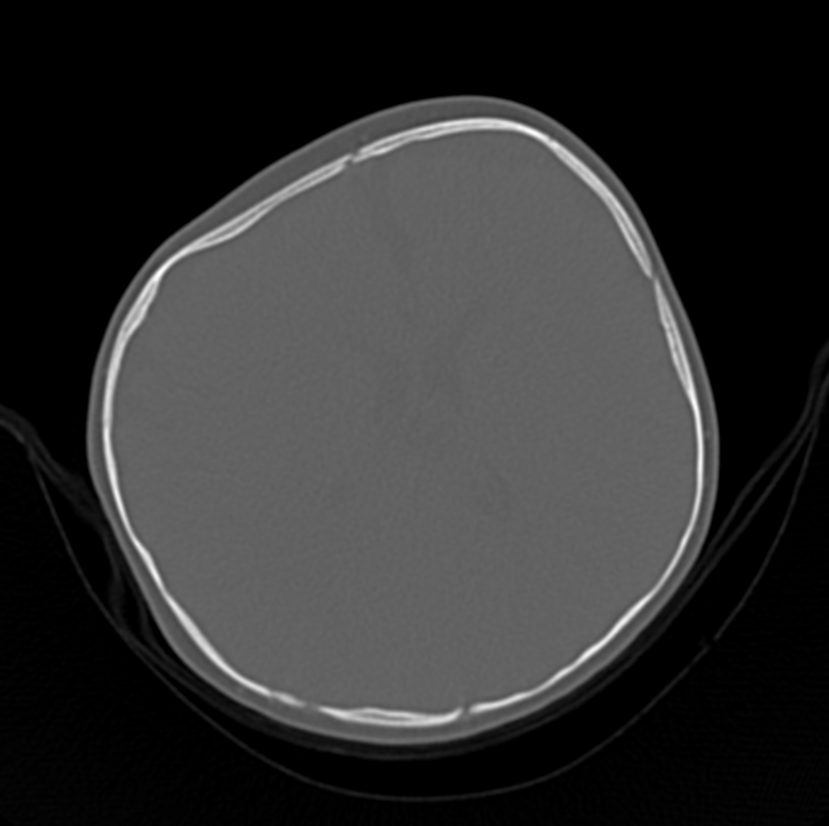 Anterior plagiocephaly | Image | Radiopaedia.org