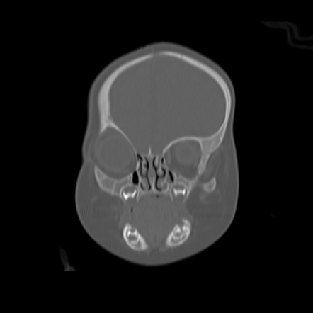 Anterior plagiocephaly | Image | Radiopaedia.org