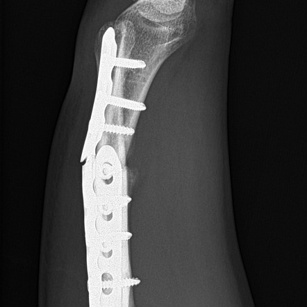 Dynamic compression plate - Wikipedia