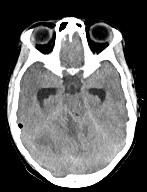 Otogenic brain abscess due to complicated otitis media and mastoiditis ...