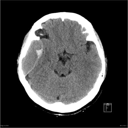 Playlist 'Core Conditions 05.1 - CNS haemorrhage pre-reading' by RMH ...