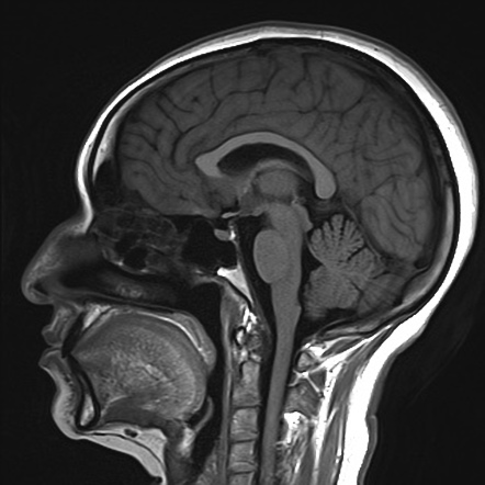 Multiple sclerosis | Image | Radiopaedia.org