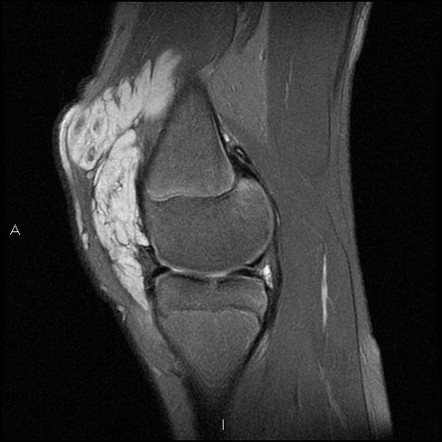 Synovial haemangioma | Radiology Case | Radiopaedia.org