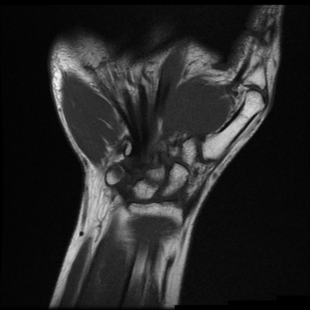 Distal intersection syndrome | Image | Radiopaedia.org