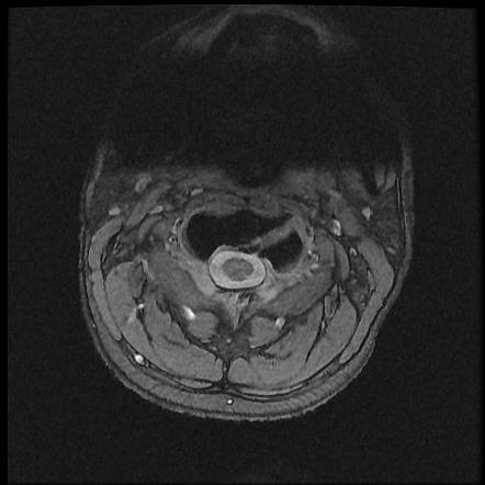 Axis fracture - MRI | Radiology Case | Radiopaedia.org