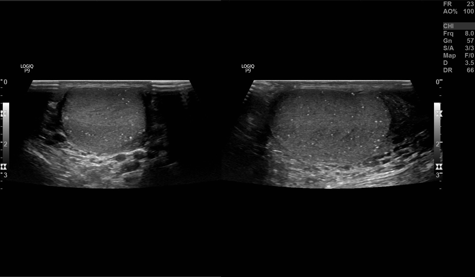 Testicular Microlithiasis Image 