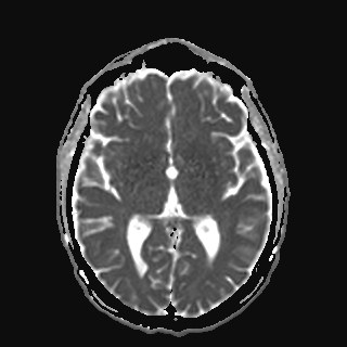 JC virus granule cell neuronopathy | Image | Radiopaedia.org