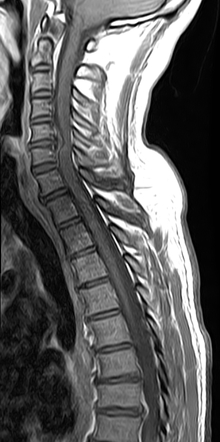 Cervical compressive myelopathy | Image | Radiopaedia.org