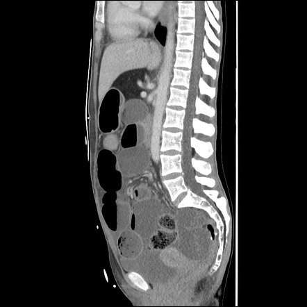 Distal intestinal obstruction syndrome | Image | Radiopaedia.org