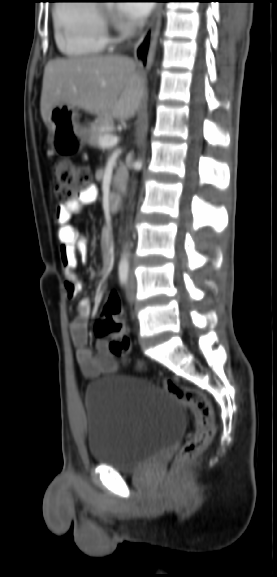 Left paraduodenal hernia | Image | Radiopaedia.org