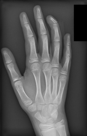 Seymour fracture | Image | Radiopaedia.org