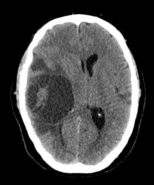 Supratentorial ependymoma | Image | Radiopaedia.org