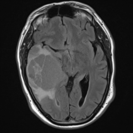 Supratentorial ependymoma | Image | Radiopaedia.org