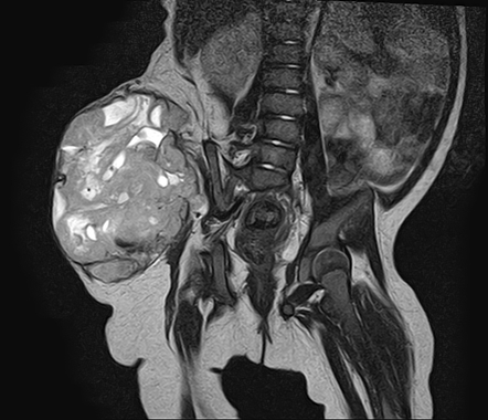 Malignant peripheral nerve sheath tumor (MPNST) | Image | Radiopaedia.org