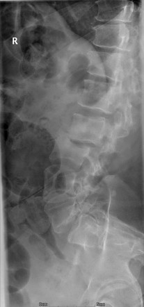 Retrolisthesis Radiology Reference Article Radiopaedia Org   0456aefa89a1ed63154089e698fd40 Gallery 