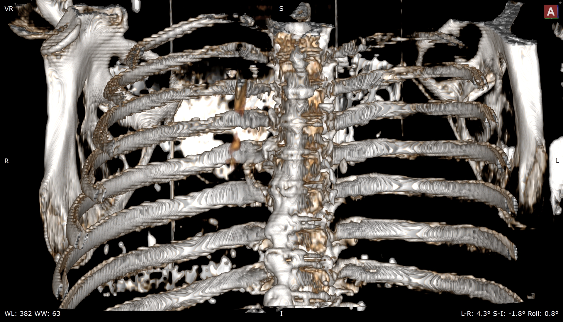 Accesory rib joint | Image | Radiopaedia.org