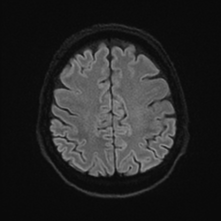 Multinodular and vacuolating neuronal tumor | Image | Radiopaedia.org