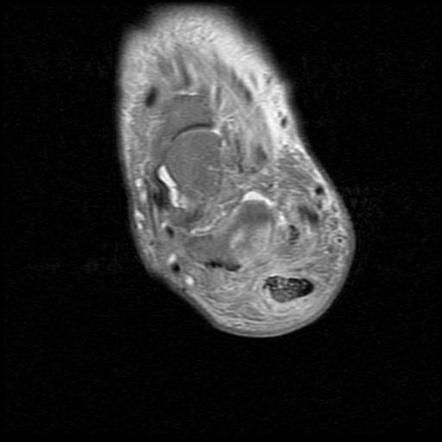 Calcaneal osteomyelitis | Radiology Case | Radiopaedia.org