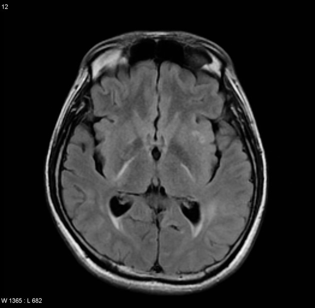 Cerebral Vasculitis 