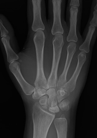 Kienböck disease | Radiology Case | Radiopaedia.org