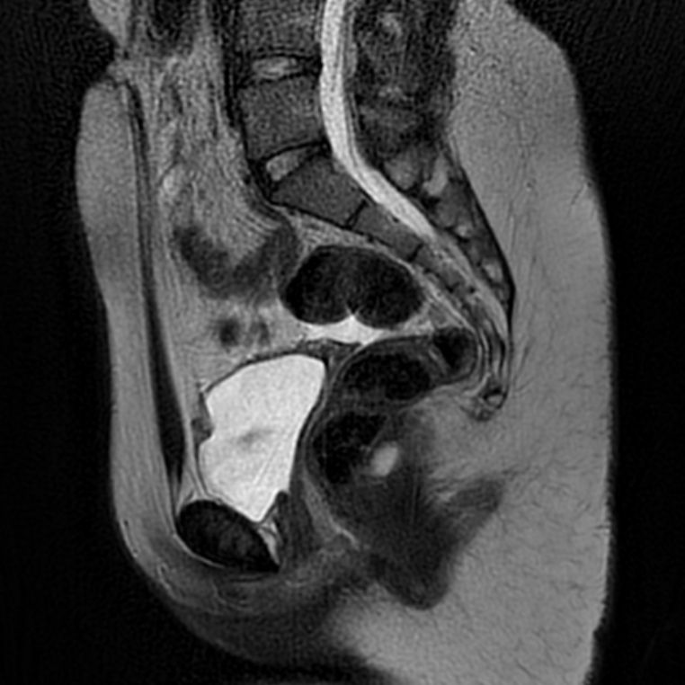 Mayer Rokitansky Küster Hauser Syndrome Image 