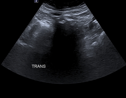 Hydatid cyst - intervesicouterine location | Image | Radiopaedia.org