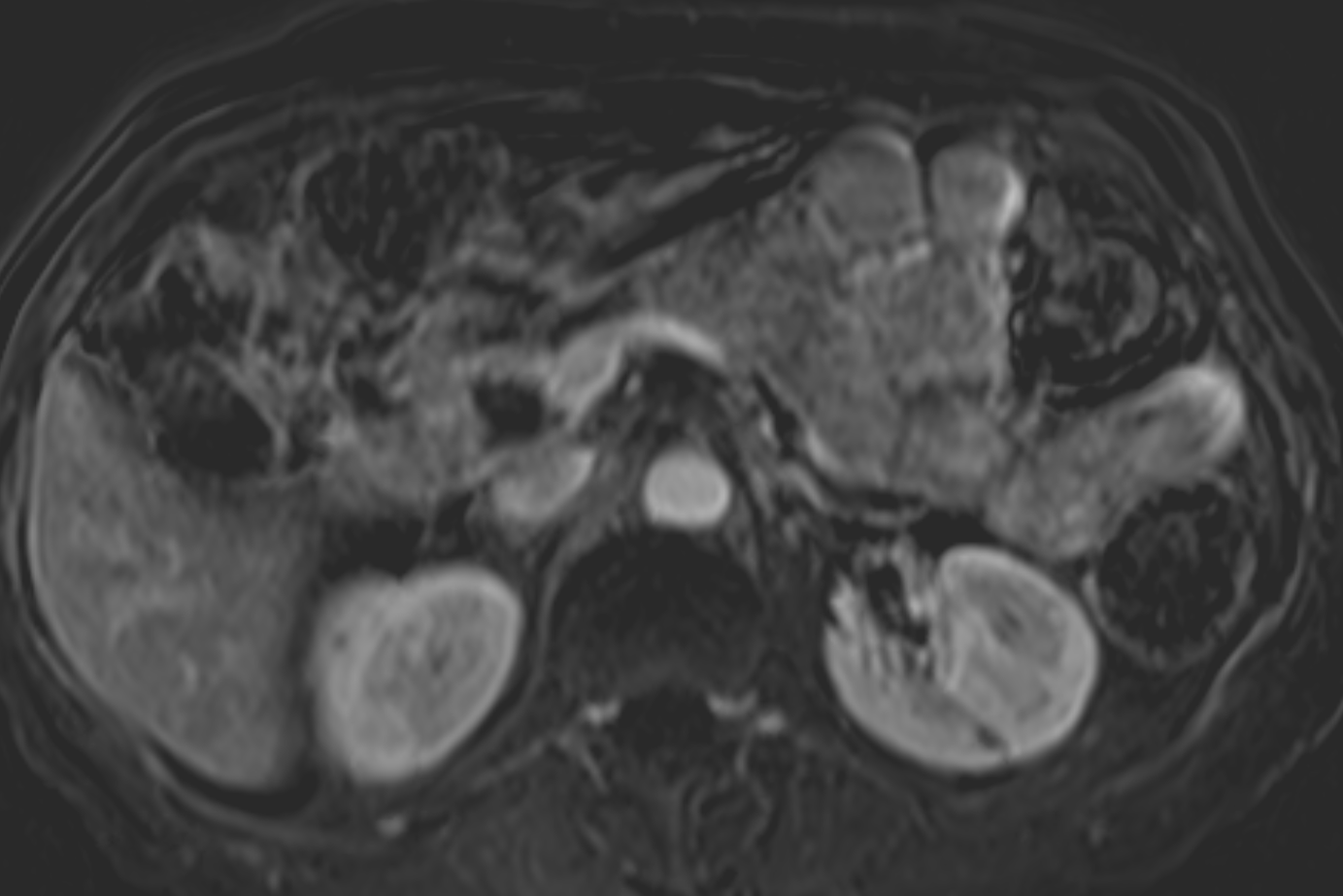 Morphine Induced Sphincter Of Oddi Dysfunction | Image | Radiopaedia.org