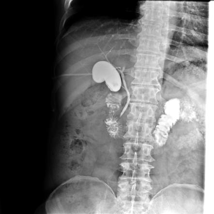 Normal T-tube cholangiogram | Image | Radiopaedia.org