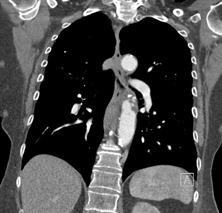 Mediastinal hematoma secondary to bronchial artery laceration following ...