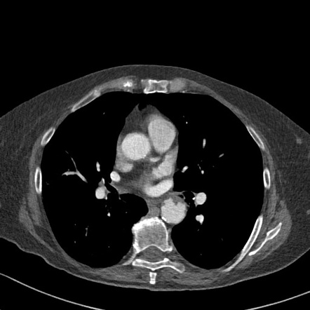 Mediastinal hematoma secondary to bronchial artery laceration following ...