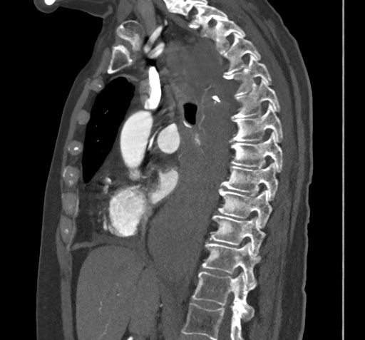 Mediastinal hematoma secondary to bronchial artery laceration following ...